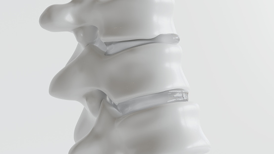 Hernia de disco espinal tan de cerca como la representación 3D photo