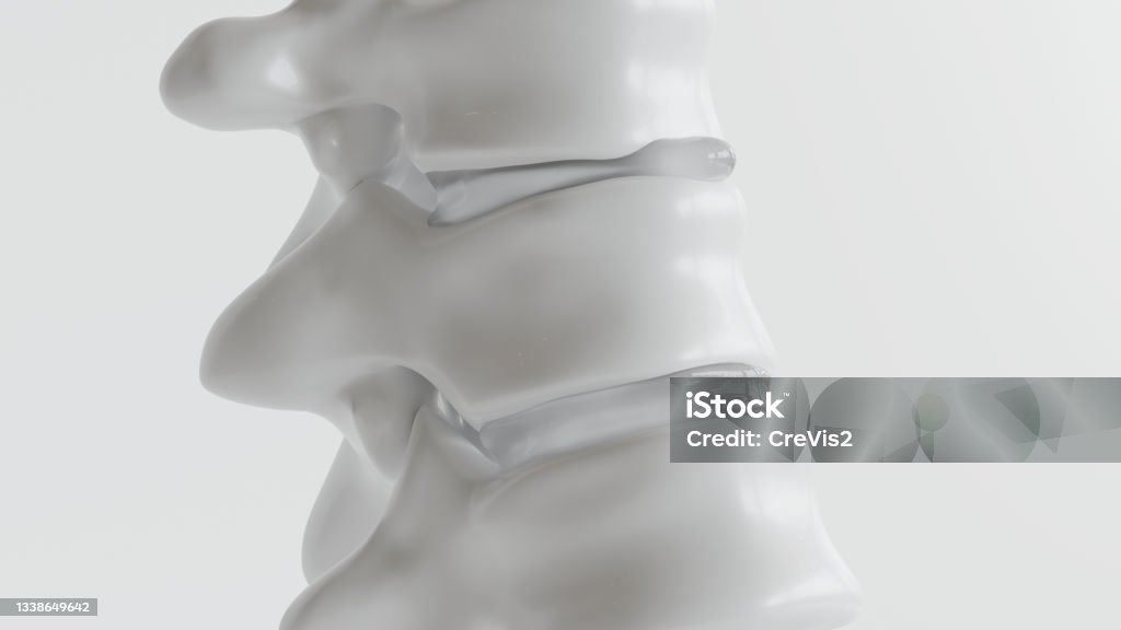 Spinal disc herniation as close-up as 3D Rendering Spine - Body Part Stock Photo