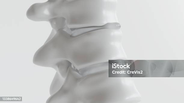 Spinal Disc Herniation As Closeup As 3d Rendering Stock Photo - Download Image Now - Spine - Body Part, Three Dimensional, Paralysis
