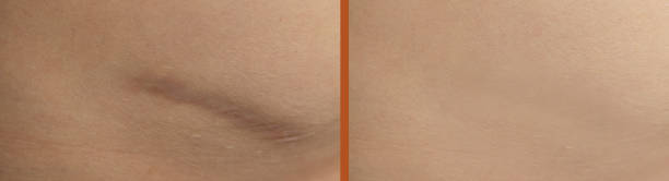 istock scar on the skin before and after treatment 1338681226