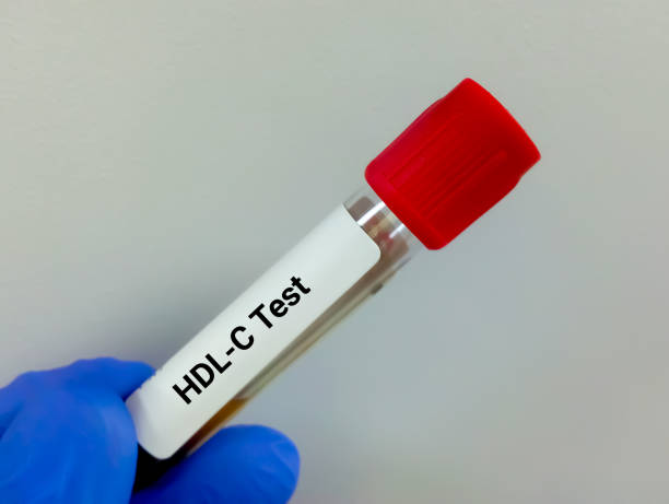 Blood sample for HDL Cholesterol test,  HDL-C, good cholesterol stock photo