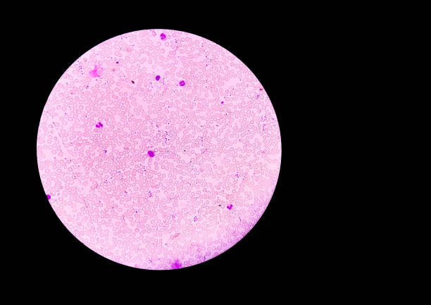 istock Hereditary hemolytic anemia. Hemoglobin E (HbE) disease is a mild, inherited blood disorder 1338791531