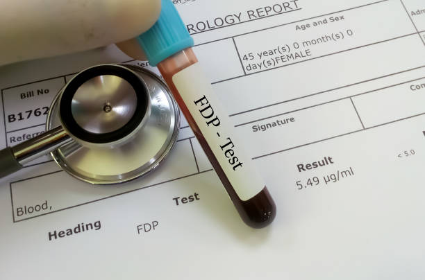 Technician hand blood tube and stethoscope isolated on FDP testing report. (Fibrin degradation product, diagnosis of coagulation disorder Technician hand blood tube and stethoscope isolated on FDP testing report. (Fibrin degradation product, diagnosis of coagulation disorder german free democratic party photos stock pictures, royalty-free photos & images