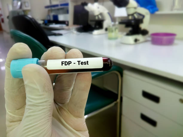 Technician hand blood tube for FDP test. (Fibrin degradation product, diagnosis of coagulation disorder Technician hand blood tube for FDP test. (Fibrin degradation product, diagnosis of coagulation disorder german free democratic party photos stock pictures, royalty-free photos & images