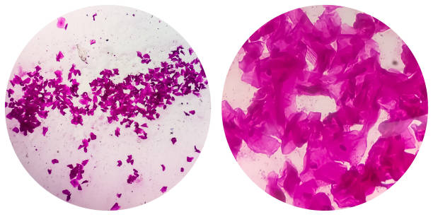 college of two microscopic image of high vaginal swab gram stain smear. diagnosis of bacterial vaginosis (bv) - klamydiatest bildbanksfoton och bilder
