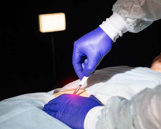 Doctor surgeon with a scalpel in his hand before bowel surgery in a patient, close-up. Small intestine part removal concept and bowel disease treatment. Copy space for text Doctor surgeon with a scalpel in his hand before bowel surgery in a patient, close-up. Small intestine part removal concept and bowel disease treatment abdominal cavity stock pictures, royalty-free photos & images