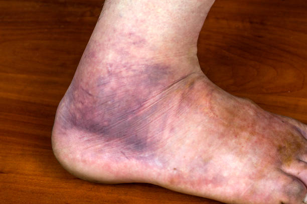 istock A huge purple bruise on the man's foot. Sprain. 1338838150