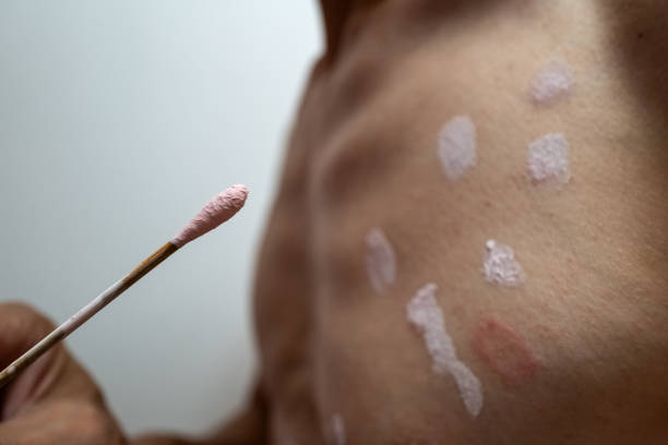 male skin disease patient being treated with medicine - frieiras imagens e fotografias de stock