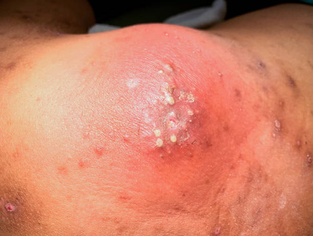 large abscess with pus under inflamed skin large abscess with pus under inflamed skin, infection with swelling and redness abscess stock pictures, royalty-free photos & images