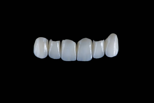 Six front dental ceramic crowns of the upper jaw on black glass background. Artificial jaw with veneers and crowns. Prosthetic dentistry.