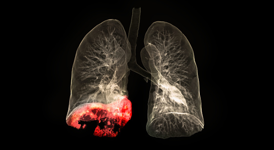 CT scan of Chest or lung 3d rendering image showing lung infection covid-19 at right lower lobe area isolated on black background.