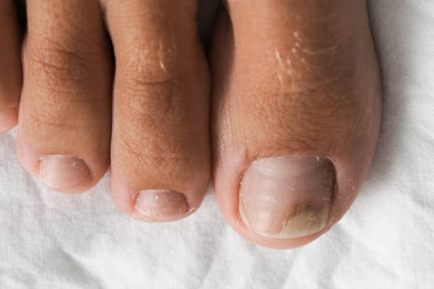 istock Bare foot with onycholysis on a toenail because of using gel-lacquer 1339132385