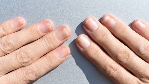 真菌性爪感染症、シェラックまたはゲルワニス後の爪切り - toenail ストックフォトと画像