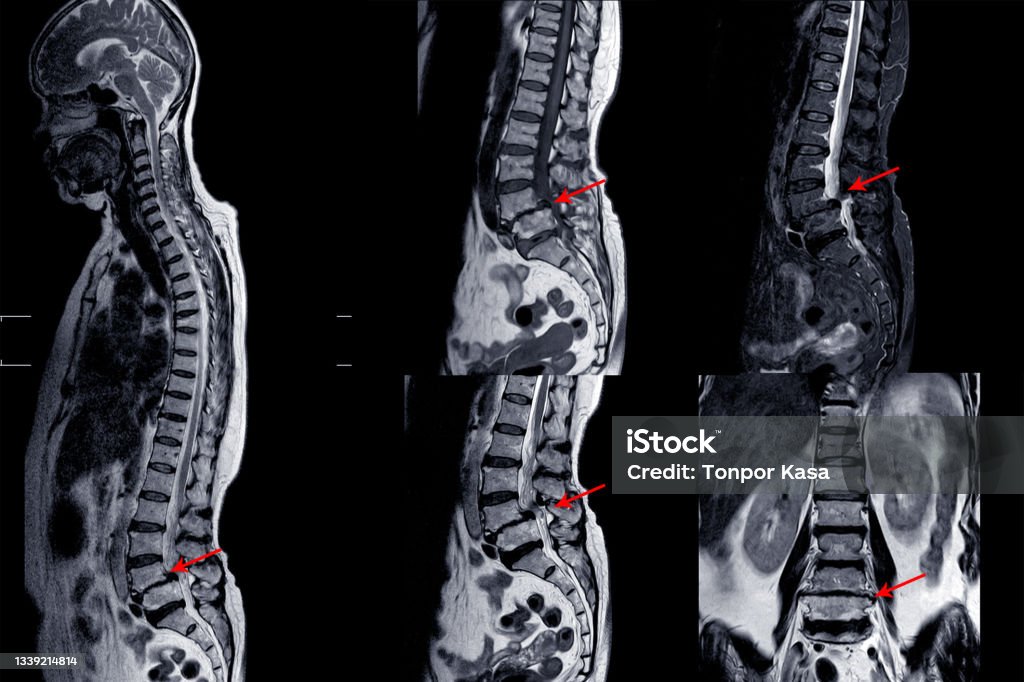 Mrt Der Lendenwirbelsäule Mit Zervikaler Spondylose Mit Leichter Bis