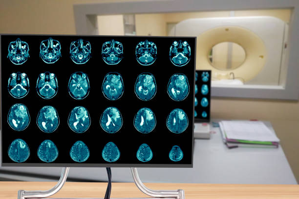 istock Magnetic resonance imaging Finding  5 cm isodense mass with ill-defined margin and surrounding edema at Left frontal lobe. Glioblastoma, brain metastasis.science and education mri brain background. 1339217721