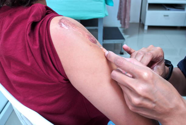vitiligo and sunburn