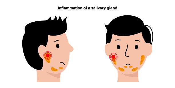 Salivary gland concept Inflammation of a salivary glands in human mouth. Parotid, submandibular, and sublingual gland. Produce of saliva through a system of ducts. Xerostomia oral disease. Medical flat vector illustration. salivary gland surgery stock illustrations