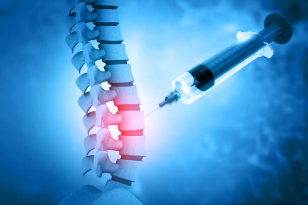 3d illustration of a lumbar spine injection - 針筒 個照片及圖片檔