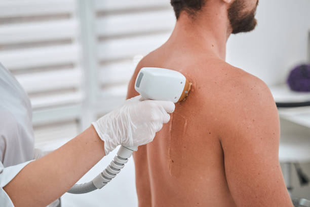 istock Patient getting a laser back hair removal 1339725432