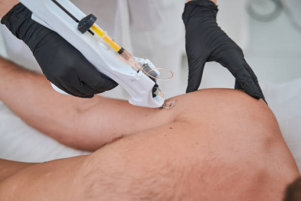 istock Dermatologist performing a skin tightening procedure with a mesogun 1339725482