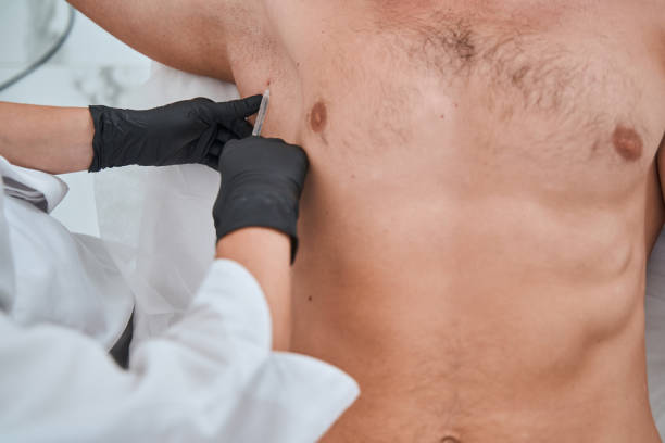 istock Man being treated for hyperhidrosis by a qualified doctor 1339725496