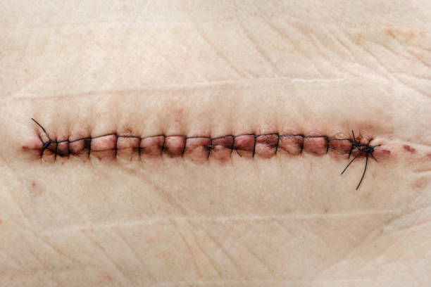 Postoperative suture on human skin SuPostoperative healing suture on human skin with black medical threads rgery on the hip. Postoperative suture on the skin with iodine. Un Stitched up skin after an operation scalpel photos stock pictures, royalty-free photos & images