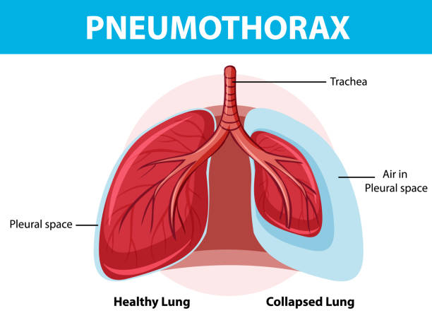 Diagramme Du Pneumothorax Avec Poumon Effondré Et Poumon Sain ...