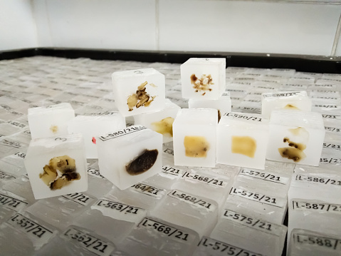 Histopathology tissue specimen paraffin block for making microscopic slide to diagnosis cancer cells, adenocarcinoma at medical laboratory.