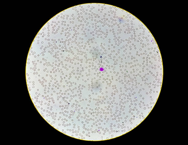 istock Microscopic view of thrombocytopenia(low platelet counts). hematology 1340253323