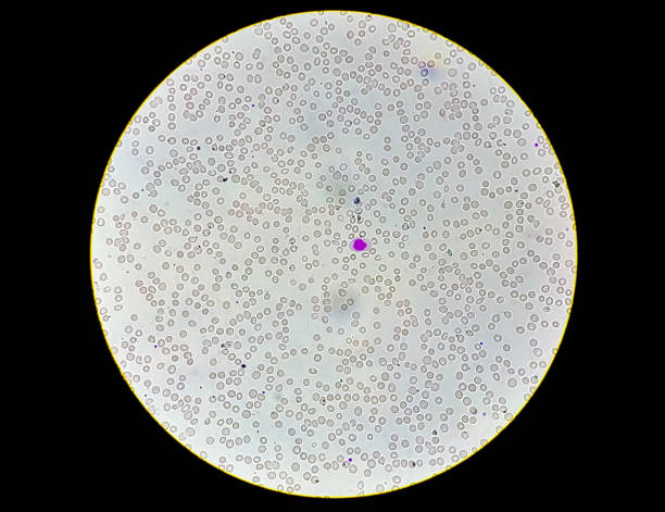 mikroskopijny widok małopłytkowości (mała liczba płytek krwi). hematologia - cancer cell flash zdjęcia i obrazy z banku zdjęć
