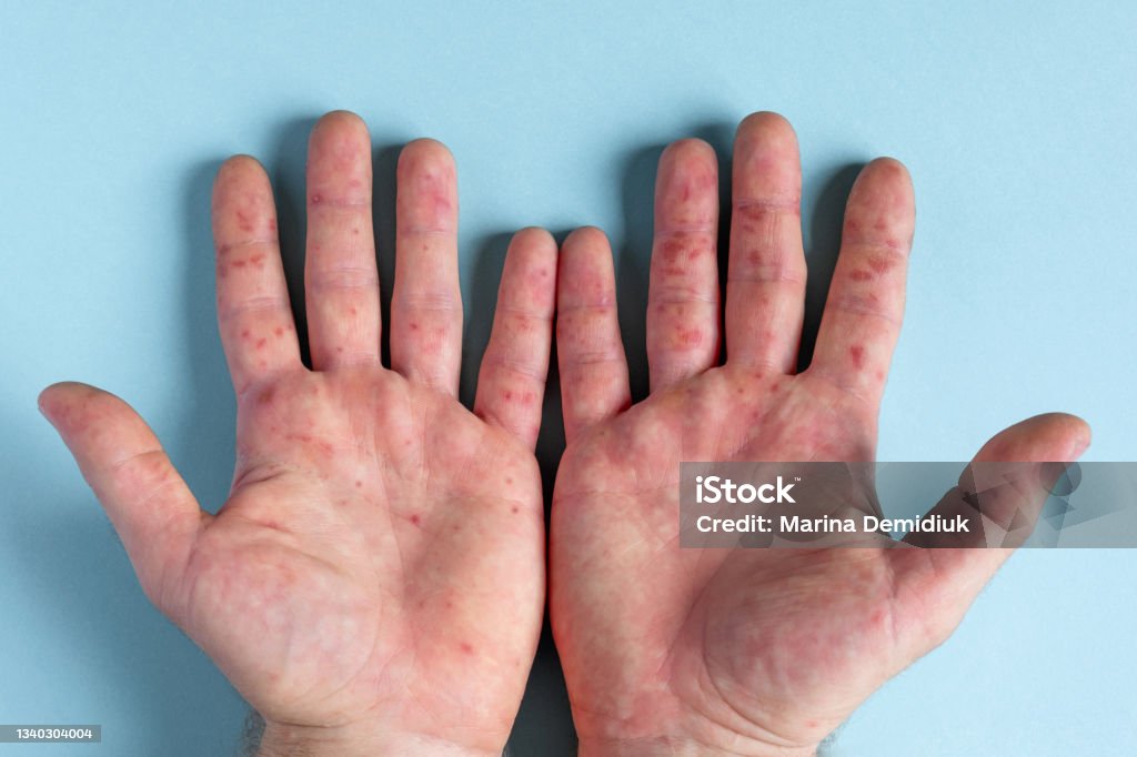 Painful Rash Red Spots Blisters On The Hand Close Up Allergy Rash Human Hands With Dermatitis And Health Problem Ill Eczema Skin Viral Diseases Red Rashes On The Palm Enterovirus