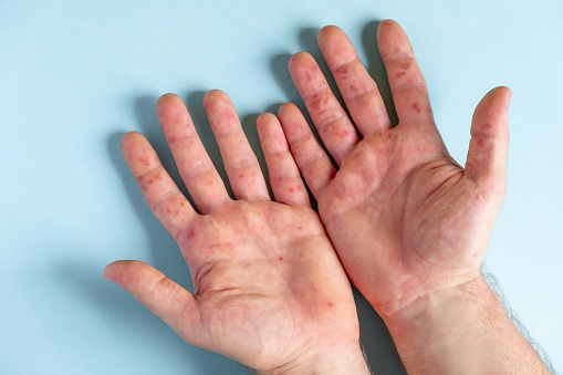 Erupción dolorosa, manchas rojas ampollas en la mano. Close up Erupción alérgica, manos humanas con dermatitis y problema de salud. Eczema enfermo de la piel del paciente. Enfermedades virales. Erupciones rojas en la palma de la mano. Enterovirus photo