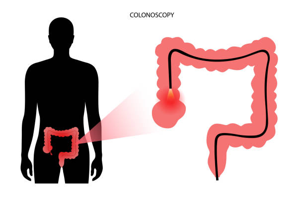 Colonoscopy procedure concept Ð¡olonoscopy exam vector illustration. Detecting changes or abnormalities in the large intestine. Colonoscope is inserted into the rectum. Video camera on the tube allows to view inside of entire colon colon cancer screening stock illustrations