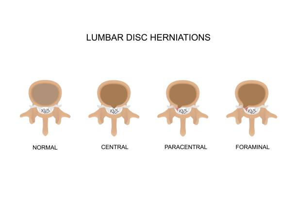 Type of lumbar disc herniations Vector illustration types of lumbar intervertebral disc herniation. Central, paracentral and foraminal disc herniation. animal back stock illustrations