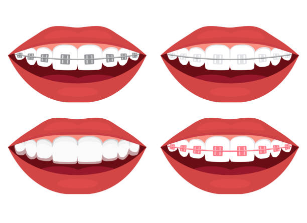 teeth alignment. Metal, ceramic, plastic, ligature and invisible braces vector art illustration