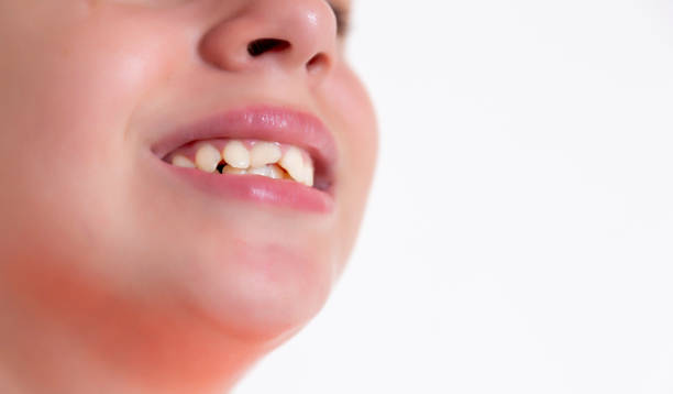 девушке выбили два передних зуба. увеличение зубов. - f04 стоковые фото и изображения