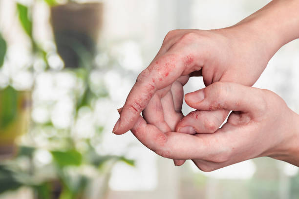 psoriasis de la peau sur les mains d’une femme. - eczema photos et images de collection