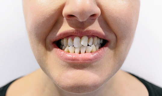 Boca de mujer con apiñamiento dental photo