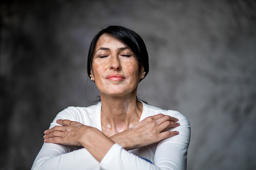 Portrait of beautiful Caucasian senior woman with skin problems Vitiligo. She is posing in studio on grey background, with closed eyes  . Skin disorder, health and illness