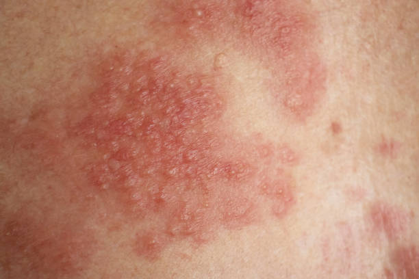 la maladie de l’eczéma sur la peau en gros plan - eczema photos et images de collection