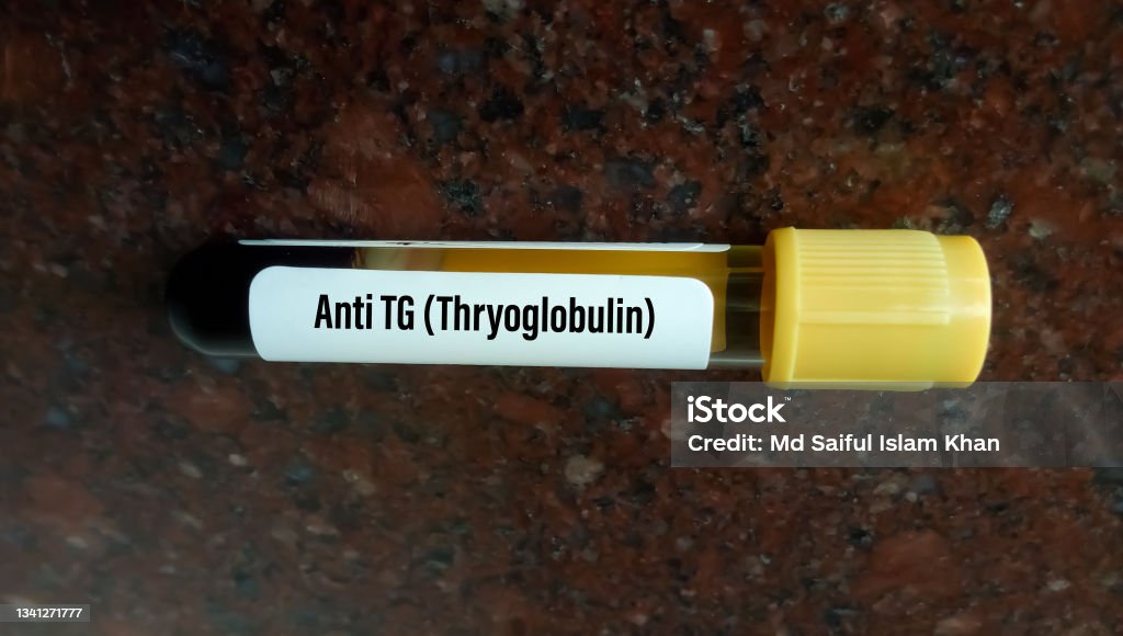 Blood Sample For Anti Thyroid Antibody Test Sle Disease Diagnosis Anti Blood Sample For Anti Thyroid Antibody Test Sle Disease Diagnosis Anti