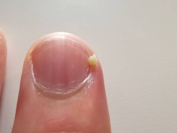新鮮な膿を伴う人間の男性の指の爪のマクロ受信 - secretory product ストックフォトと画像