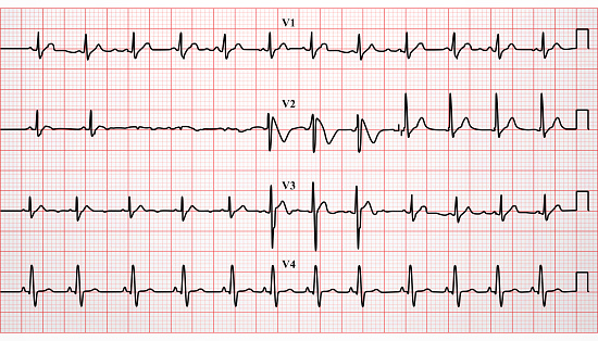 Electrocardiogram, ECG, heartbeat in vector format