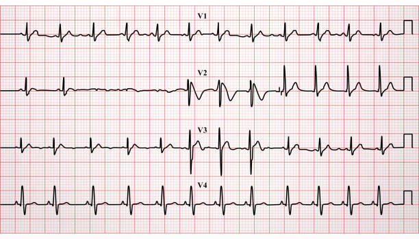 Electrocardiogram Ecg Heartbeat Vector Stock Illustration - Download Image  Now - Electrocardiography, Heart - Internal Organ, Chart - iStock
