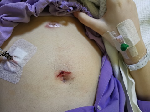 A raw scar from post surgery to treat appendicitis.