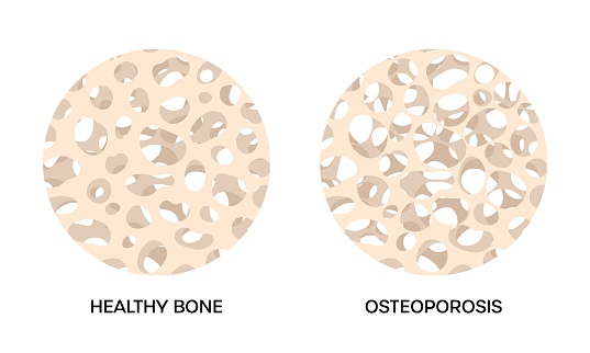 Bone tissue damaged by osteoporosis, compared with healthy bone human. Normal and thinning skeleton spongy structure, vector illustration