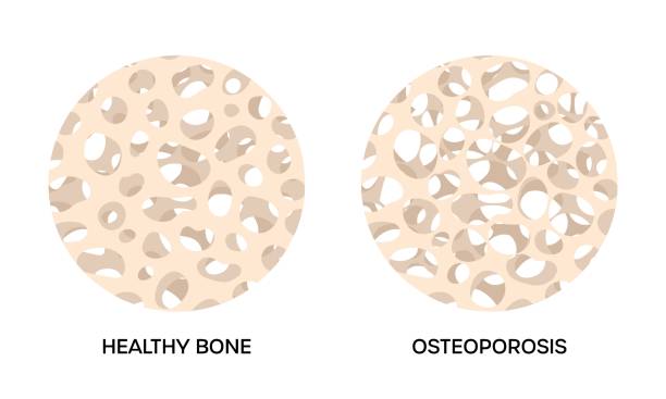Healthy and osteoporosis bone, round illustrations on white background Bone tissue damaged by osteoporosis, compared with healthy bone human. Normal and thinning skeleton spongy structure, vector illustration human tissue stock illustrations