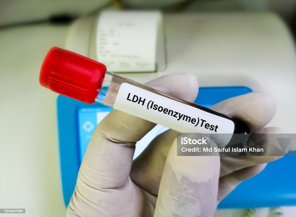 Blood Sample Tube For Ldh Test Lactate Dehydrogenase Diagnosis For Blood Sample Tube For Ldh Test Lactate Dehydrogenase Diagnosis For
