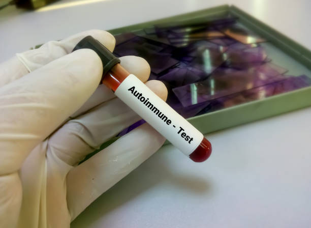 Blood sample for autoimmune disease test. diagnosis of autoimmune disorder Blood sample for autoimmune disease test. diagnosis of autoimmune disorder autoantibody stock pictures, royalty-free photos & images