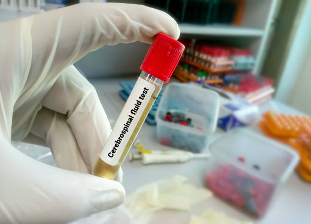 Scientist or Biochemist hold Cerebrospinal fluid test including Glucose, Protein, ADA Scientist or Biochemist hold Cerebrospinal fluid test including Glucose, Protein, ADA cerebrospinal fluid photos stock pictures, royalty-free photos & images